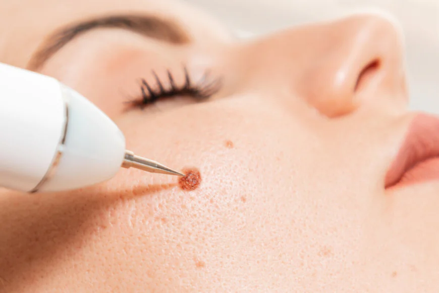 Is Warts Removal Treatment Suitable for Sensitive Skin?