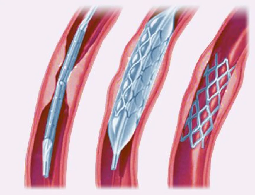 Global Angioplasty Balloons Market Size, Share, Trends, and Growth Forecast 2026-2033