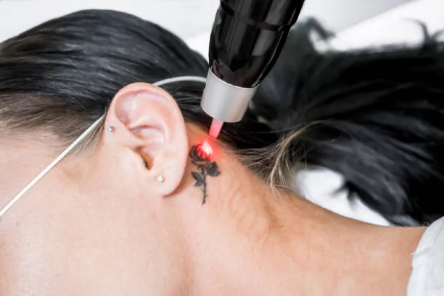 What Makes Laser Tattoo Removal Effective?