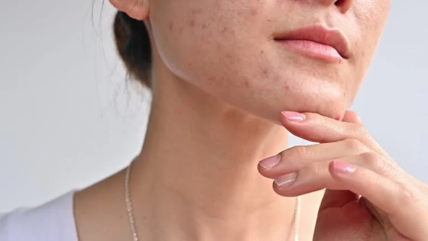 Is Acne Treatment Suitable for Adult Acne?