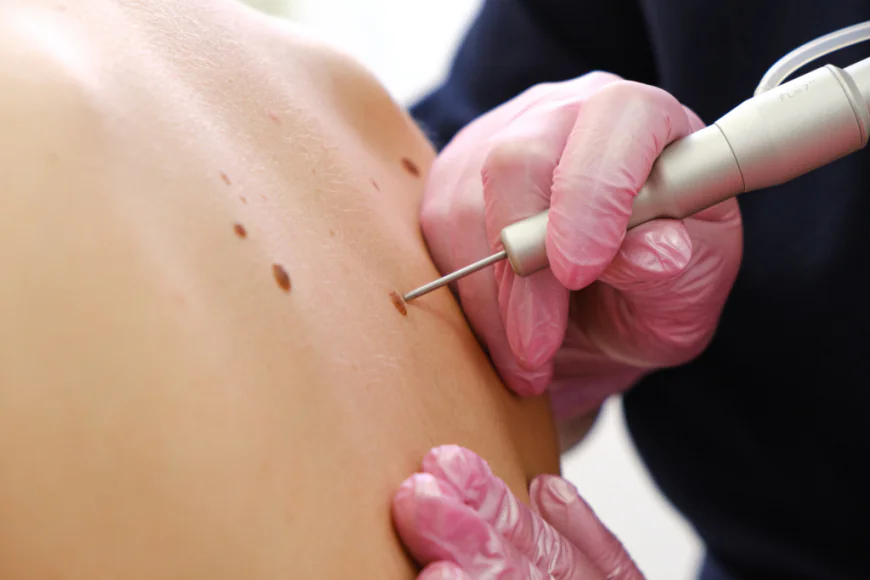 How Much Does Professional Wart Removal Cost in Dubai?
