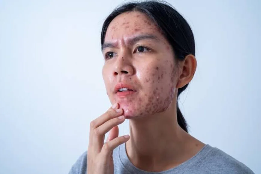What factors influence the results of Acne Treatment?