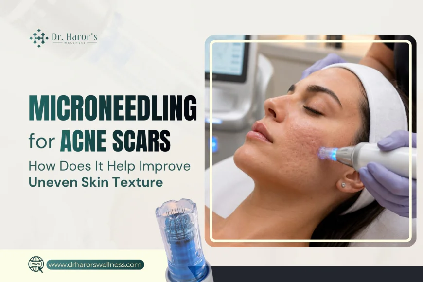 Microneedling for Acne Scars: How Does It Help Improve Uneven Skin Texture?