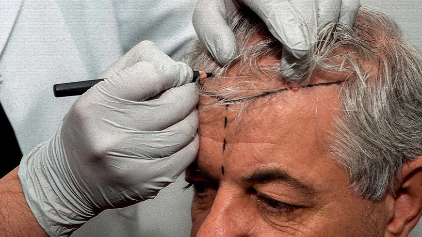 What to Look for in a Clinic’s Approach to Hair Density and Coverage