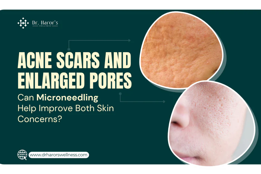 Acne Scars and Enlarged Pores: Can Microneedling Help Improve Both Skin Concerns?