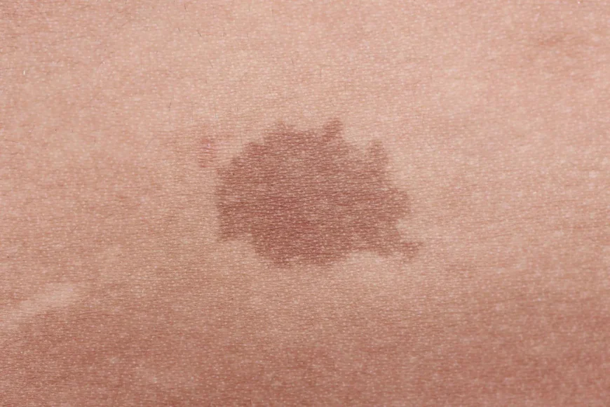 Is Birthmark Removal treatment Appropriate for Raised Birthmarks?