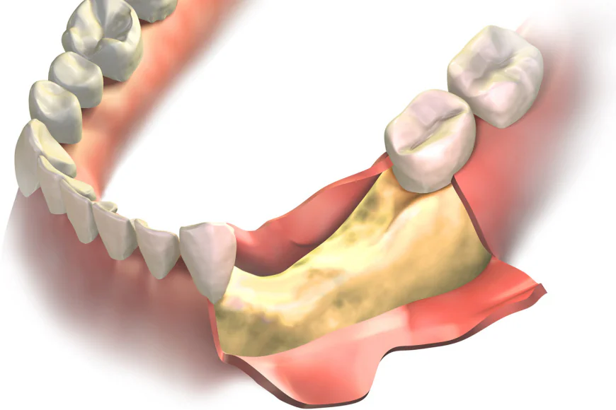 Rebuild Bone Structure with Professional Bone Grafting in Hayward, WI