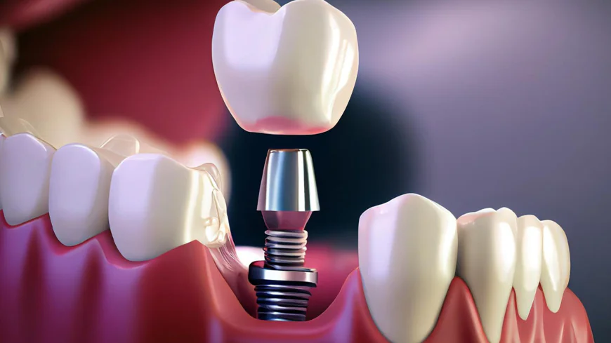 Could Dental Implants Be the Right Solution for Missing Teeth?