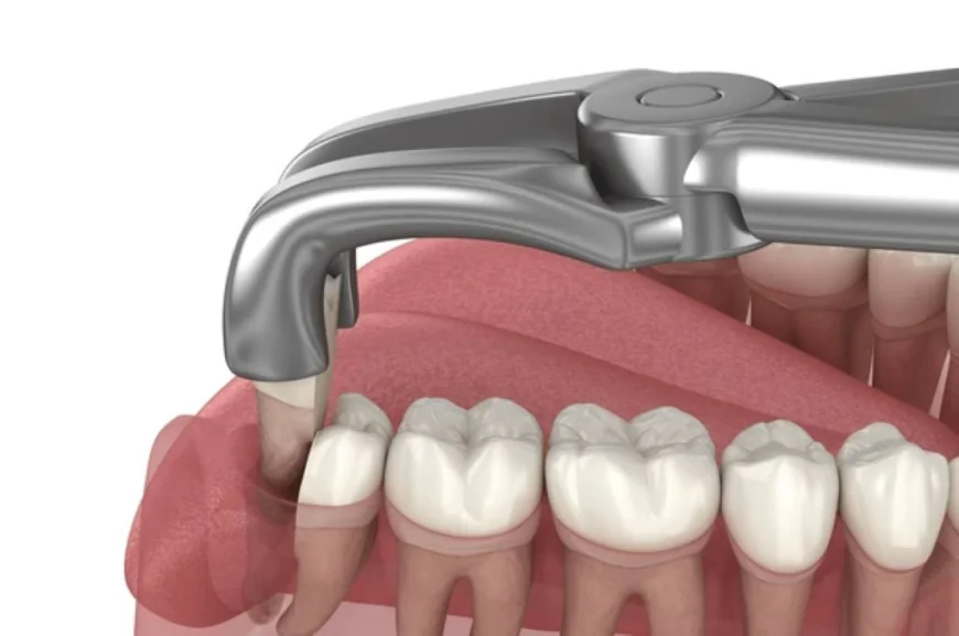 Wisdom Tooth Removal Near Me and Family Dentist Houston: Complete Care for Every Smile