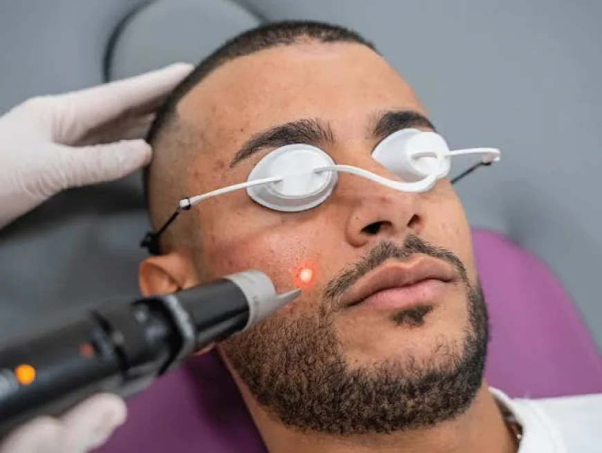 Is Pico Laser Treatment Effective for Sun Damage?