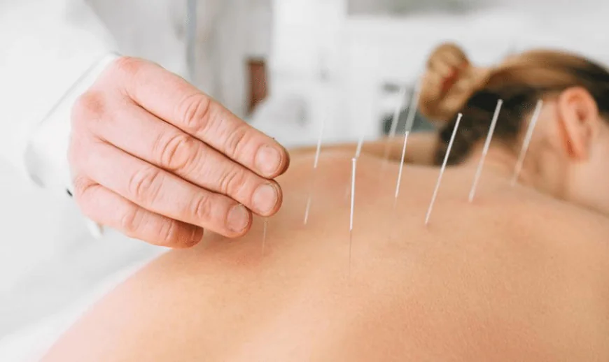 What Is Acupuncture for Stress and Anxiety and How Can It Help?