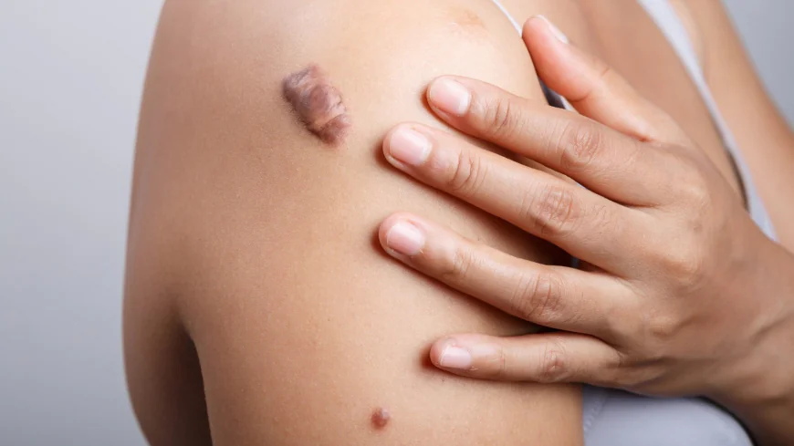 Is Keloid Treatment Effective for Acne Scars?
