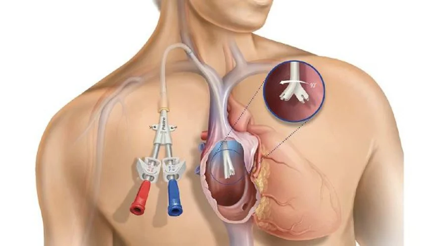 Transcatheter Embolization and Occlusion Devices Market Size, Trends, and Growth Analysis