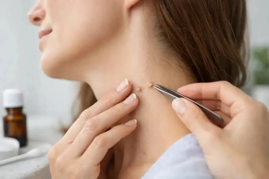 Remove Unwanted Skin Growths with Expert Care