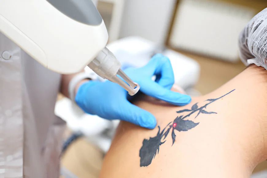 What Makes Picosure Tattoo Removal So Effective?