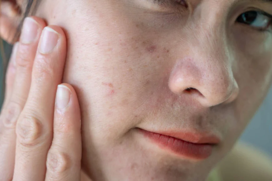 How Can Facial Capillaries Be Managed on Delicate Facial Skin?