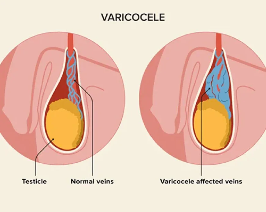 Microsurgical Varicocelectomy in Lucknow: Advanced Treatment for Varicocele