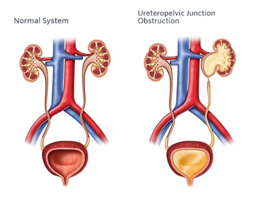 Pyeloplasty Surgery in Lucknow