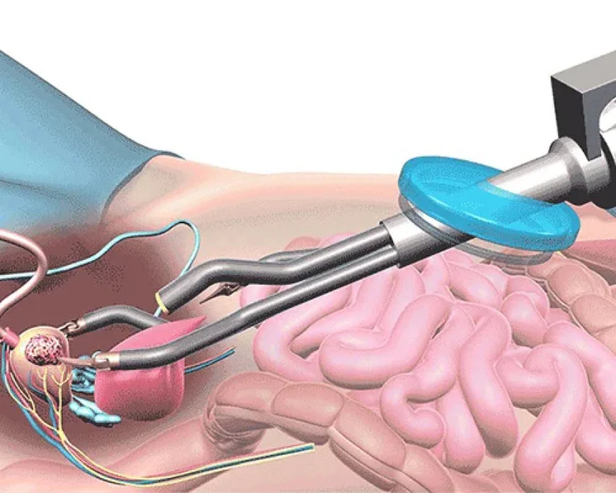 Robotic Radical Prostatectomy in Lucknow