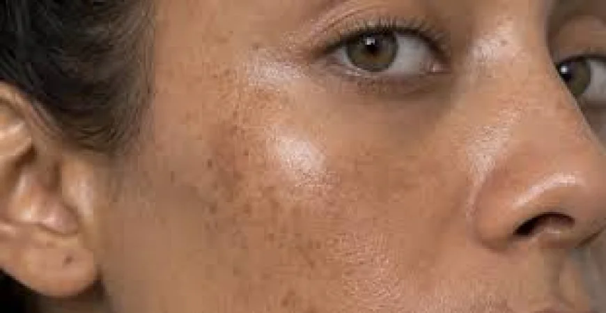 Melasma Treatment in Singapore: Is Laser Safe and Effective?