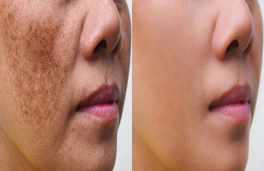 Skin Brightening and Pigmentation Treatment in Dubai | Glamorous Clinic Dubai